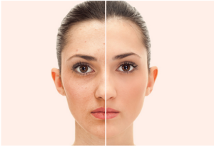 facelift